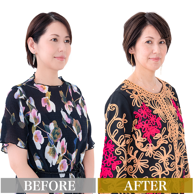 アクアドールのヘアピース「総手植え人毛MIXヘアピース リアルスキン ナチュラル」のビフォーアフター
